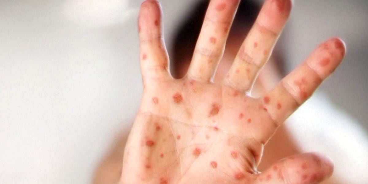 Measles case confirmed in Vermont - WCAX